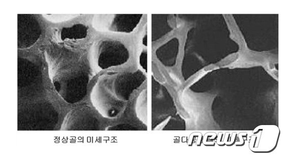 정상(왼쪽)과 골다공증이 발생한 뼈 구조./뉴스1 © News1
