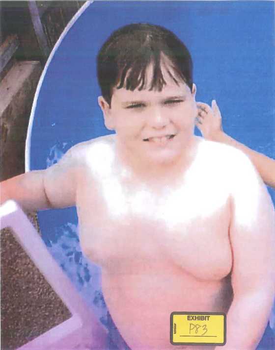여성유방증을 앓고 있는 오스틴이 수영장에서 물놀이를 즐기고 있다. 당시 그의 나이 10세.©