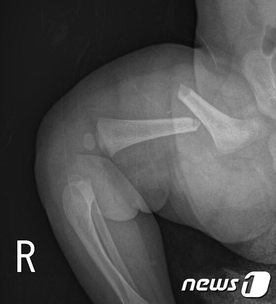허벅지 뼈가 부러진 생후 50일 수연이(가명)의 엑스레이(X-ray) 사진. © News1 박효익 기자