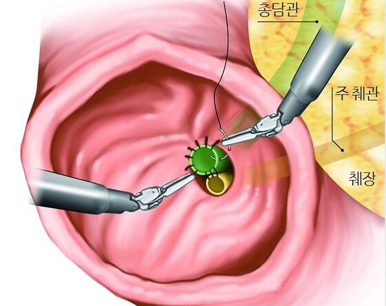 십이지장 팽대부 종양 환자에 대한 로봇수술 모식도./© News1