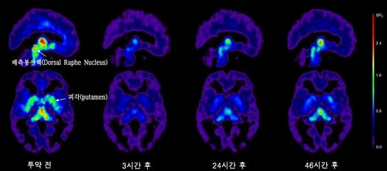 에스시탈로프람 투여 전과 3시간 24시간 46시간 후에 측정한 뇌영역 수용체 점유율© News1