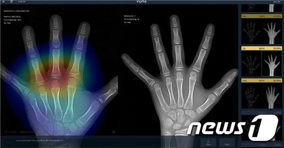 뷰노가 개발한 뼈나이 판독 인공지능(AI) 의료기기 '뷰노메드 본에이지' 모습.© News1