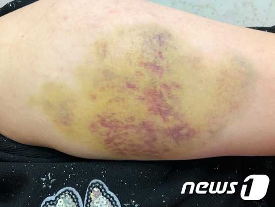 고등학생들로부터 폭행당한 여중생의 팔 부위가 시퍼렇게 멍이 든 모습.(SNS 페이스북 캡처)© News1