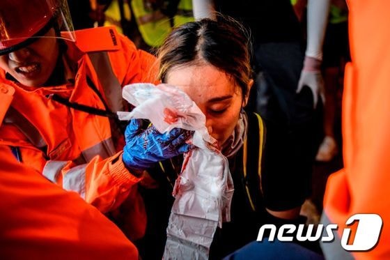 11일 홍콩 침사추이에서 열린 집회 도중 경찰이 쏜 빈백건에 맞아 오른쪽 안구가 파열된 여성 시위 참가자. (CNN) © 뉴스1