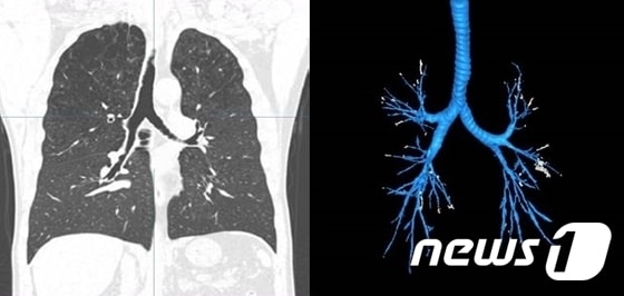 만성폐쇄성폐질환(COPD) © 뉴스1