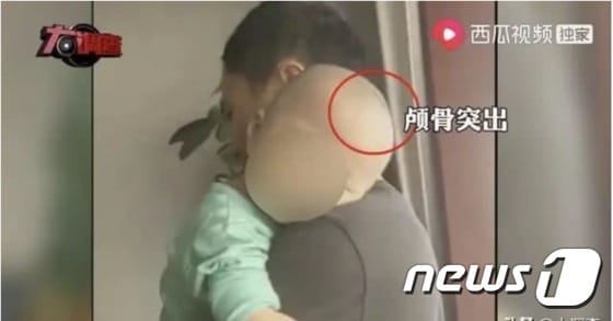 가짜 분유를 먹고 두개골이 커지는 부작용이 나타난 중국 아기(출처=신경보 갈무리)© 뉴스1