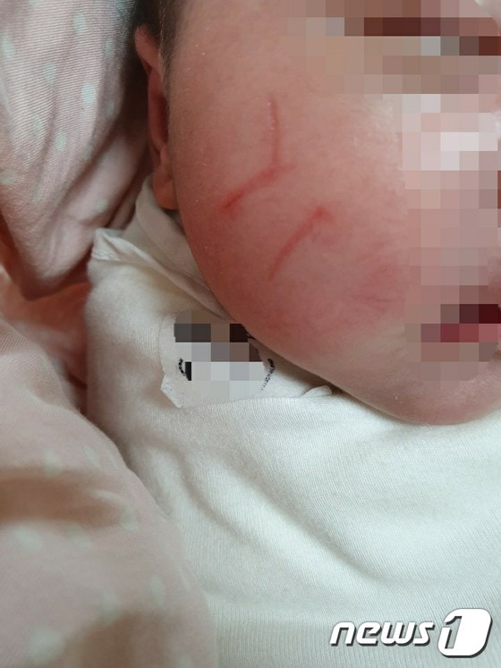 B씨의 아기가 지난해 수원 영통구 소재 산후조리원에서 당한 피해사례.(제보자 제공)© 뉴스1
