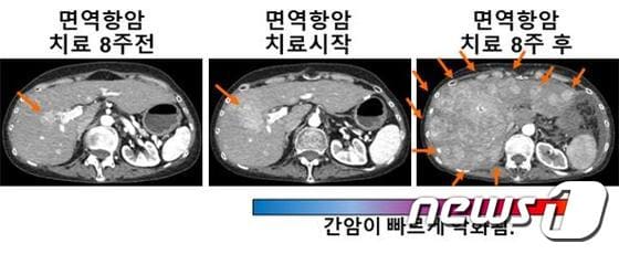 간암의 급성진행을 보여주는 간암 환자의 CT 사진© 뉴스1