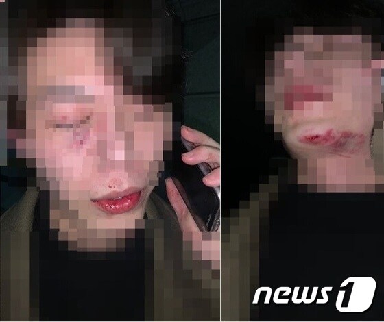 춘천 무차별 폭행사건 피해사진(피해자 가족 측 제공) © 뉴스1