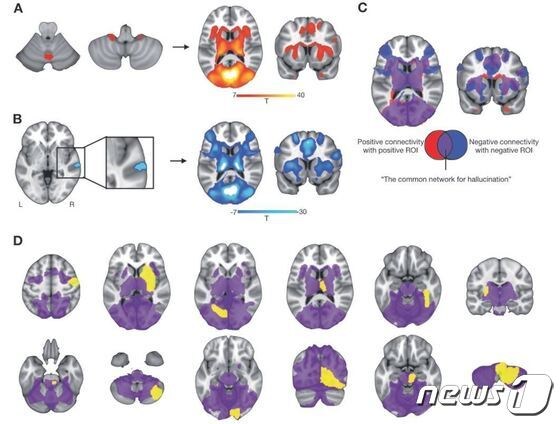 <br />소뇌를 중심으로 하는 뇌 연결망(A)과 우측 위측두엽을 중심으로 하는 뇌 연결망(B)은 서로 겹치는 부분이 있으며(C), 환각을 유발하는 병변들 중 대부분이 소뇌 및 우측 위측두엽이 중심이 돼 구성하는 뇌 연결망에 위치하는 것으로 확인됐다.(D)(병원측 제공)© News1 