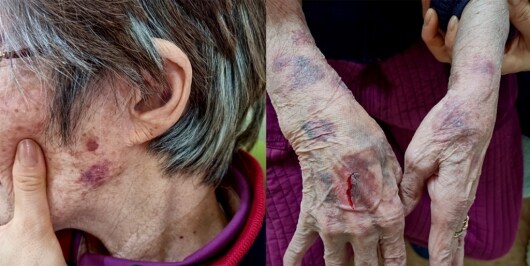경북 김천의 한 노인주간보호센터에서 80대 치매 노인이 직원들로부터 집단폭행을 당했다. (온라인 커뮤니티 갈무리) © 뉴스1