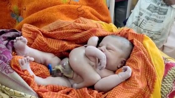 인도에서 팔, 다리가 각각 4개인 아기가 태어났다. (데일리스타 갈무리)© 뉴스1