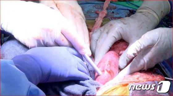 19일(현지시간) 미국 앨러바마대 의료진이 유전자 조작 돼지의 심장을 뇌사 상태 환자의 복부에 이식하고 있다. 2022.01.19 © AFP=뉴스1