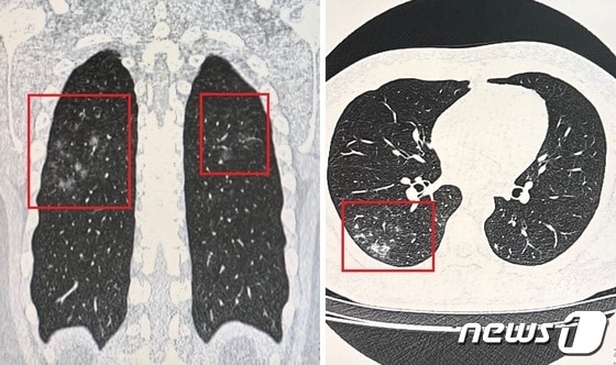 코로나 후유증 클리닉에 폐렴 진단을 받았다. 폐의 세로 단면 CT 사진(왼쪽)과 가로 단면 CT 사진. 뿌옇게 번진 부분이 폐렴이 나타난 부위라는 설명을 받았다. 2022.04.14./뉴스1 © News1 김정현 기자