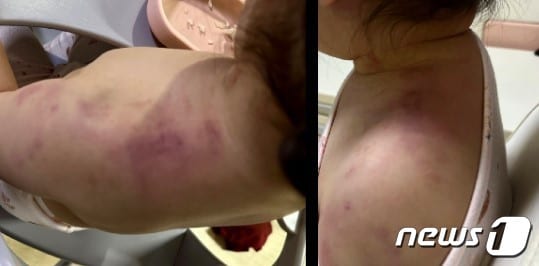 지난 1월 안산의 한 어린이집에서 두 돌 된 여자아이가 담임교사에게 몸으로 압박당해 피멍이 드는 사건이 발생했다. ('보배드림' 갈무리)