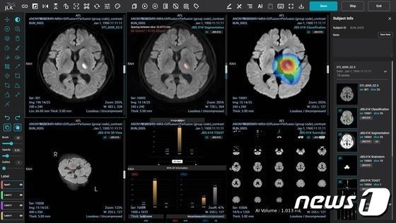 제이엘케이 뇌졸중 유형 판별 솔루션 JBS-01K 활용 모습.(제이엘케이 제공)/뉴스1 © News1