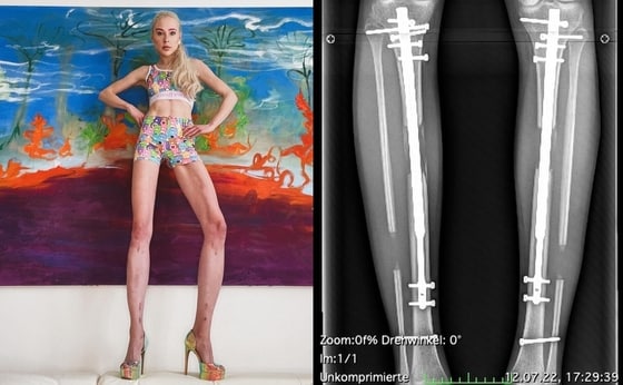 사지연장술을 받고 다리길이를 14㎝나 늘인 독일 모델. (테레지아 피셔 인스타그램)
