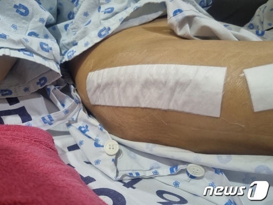 골절됐던 천 씨의 오른쪽 고관절 부위. 수술 받은 흔적이 드러나 있다. © 뉴스1 박혜연 기자