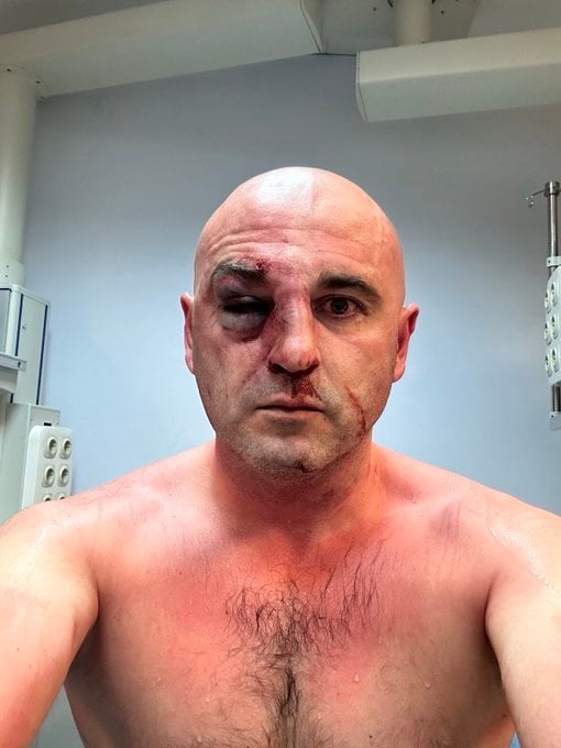 레반 카베이슈빌리 조지아 통합민족운동당 대표가 시위 중 경찰에 폭행당했다며 찍어올린 사진. <출처=레반 하베이슈빌리 엑스 갈무리>